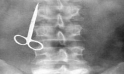 طبيب سعودي ينسى “مقص” في بطن مريضه