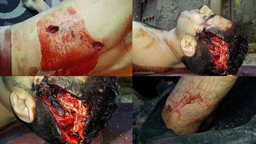 بالصور: آثار رصاص القوات السعودية على جسدي الشهيدين محمد النمر ومقداد النمر قبل تسليمهما للمستشفى