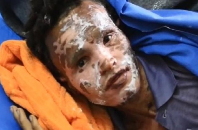 أسلحة محرمة تذيب العظام يستخدمها العدو السعودي ضد اليمنيين