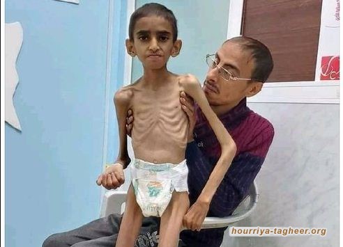 مرصد دولي: الحرب تدفع 20 مليون يمني نحو الفقر المدقع