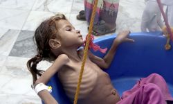 السعودية عرضت اليمن لأسوأ أزمة إنسانية في العالم
